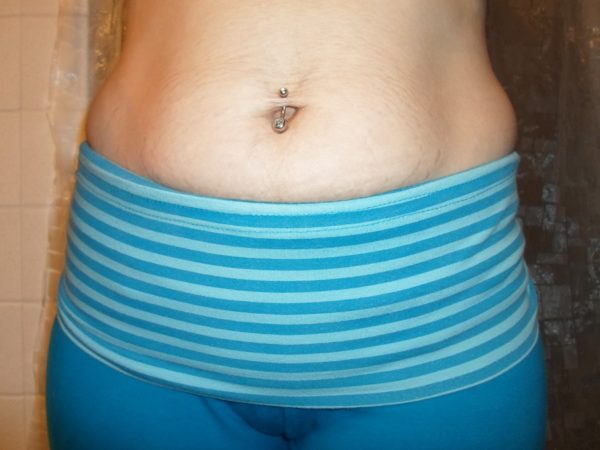 Emu oil treats stretch marks
