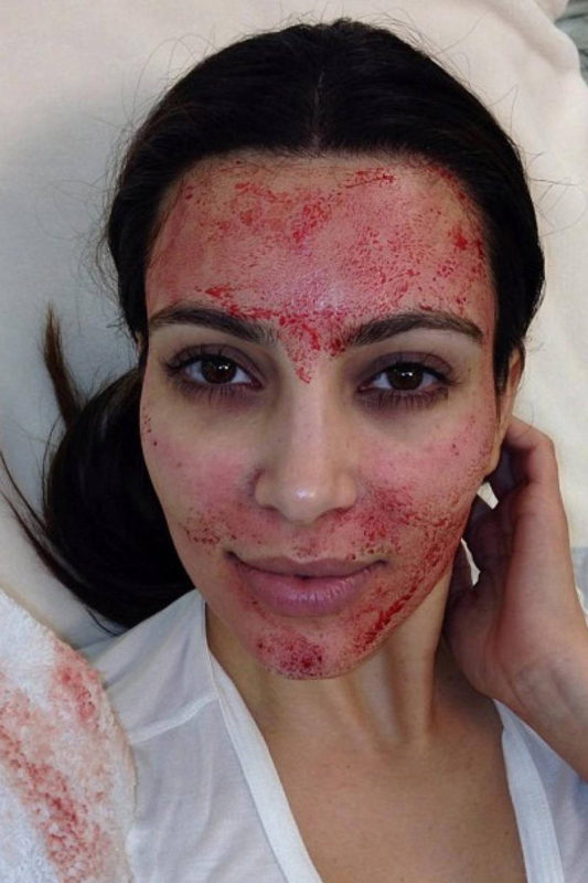 Kim Kardashian vampire facial