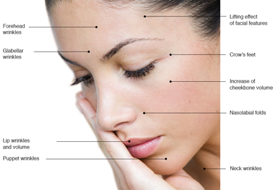Fillerina effects on areas of face